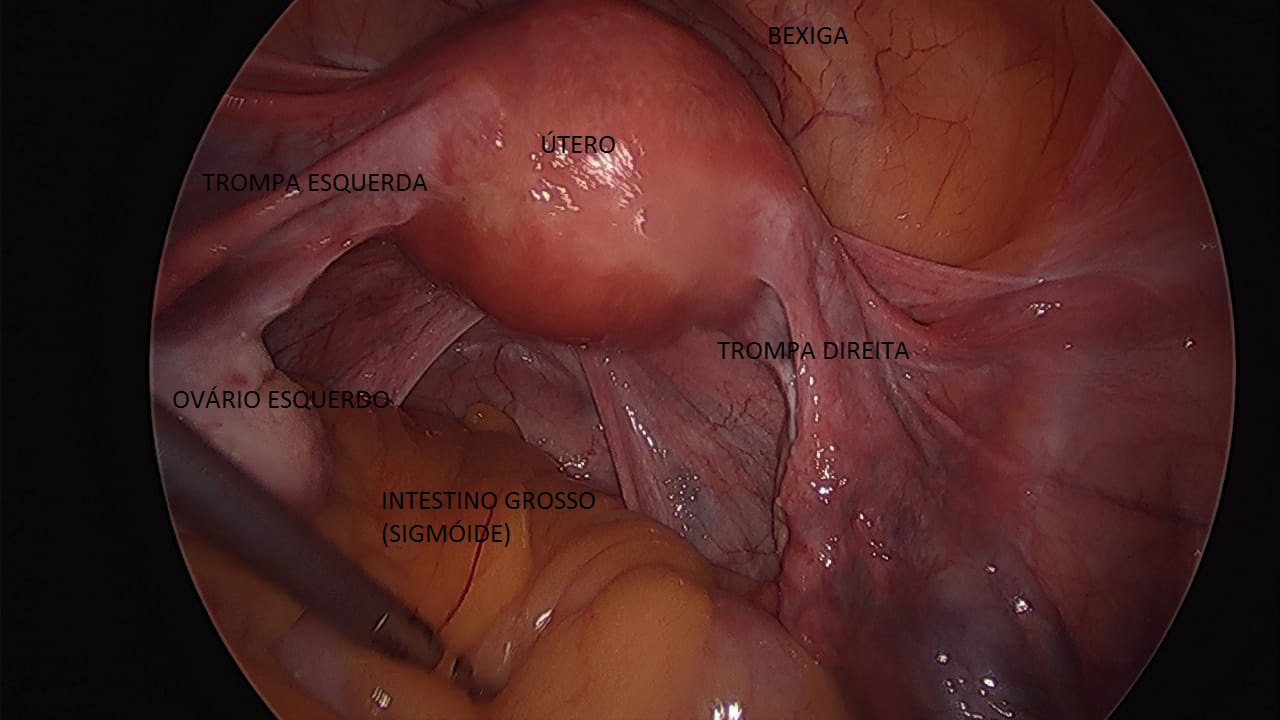 Imagem de orgãos pélvicos normais video laparoscopia