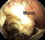ressecção mioma (miomectomia)