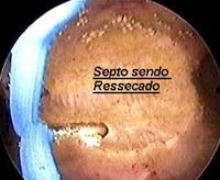 histeroscopia ressecção de septo uterino