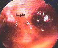 histeroscopia septo uterino