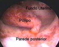 histeroscopia pólipo endometrial